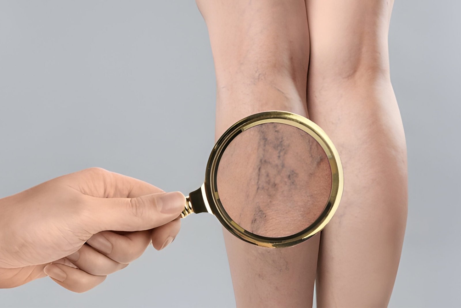 Best Varicose Veins Treatment in Madurai