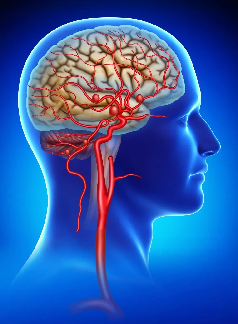 Brain Aneurysm Treatment Madurai
