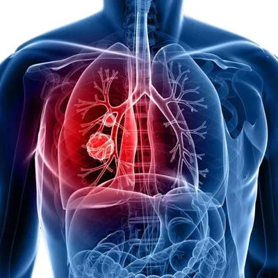 Interventional Oncology Treatment Madurai