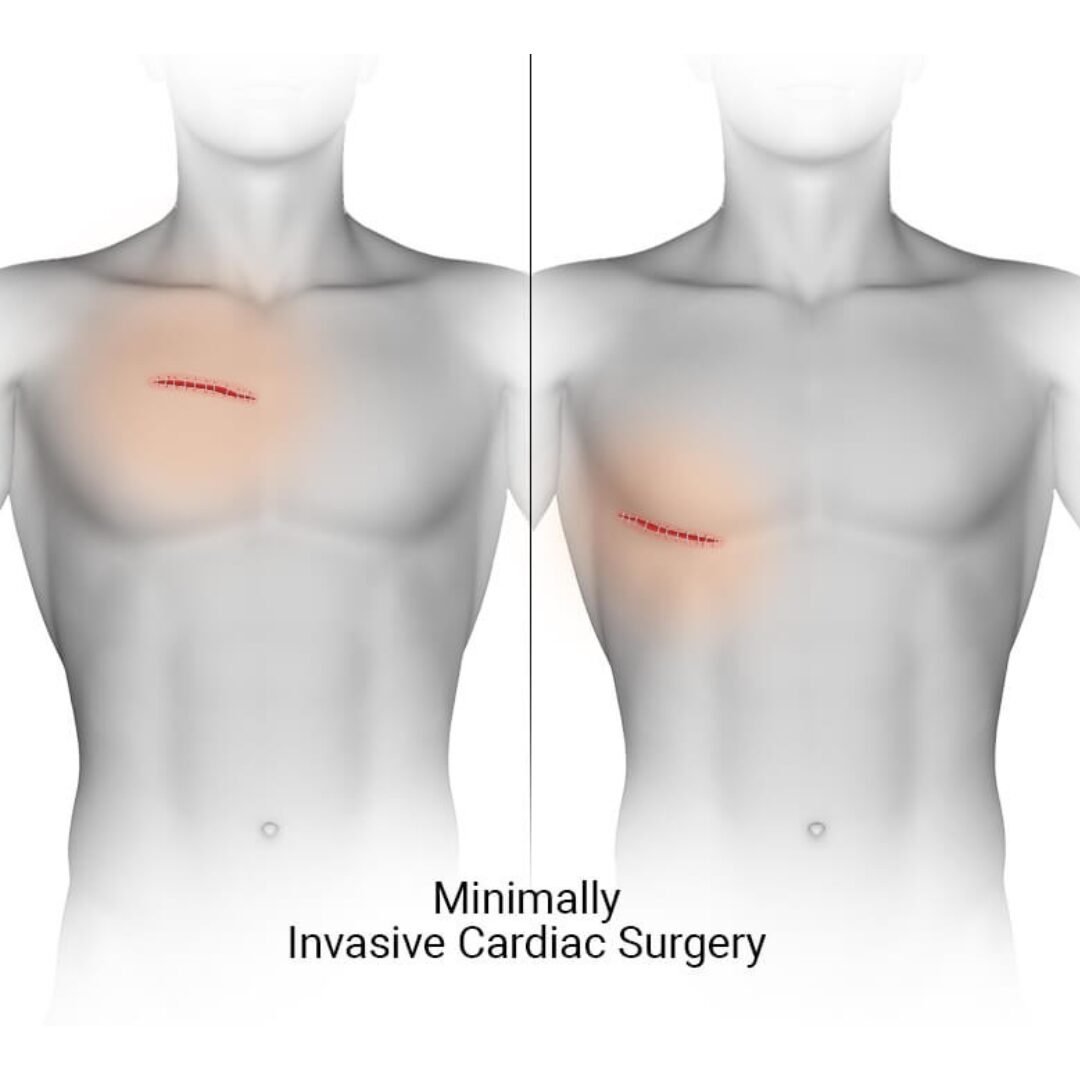 Minimally Invasive Treatment