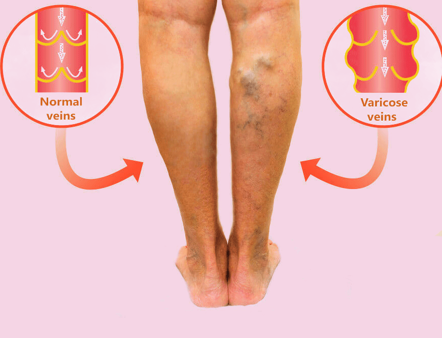 varicose veins treatment in Madurai