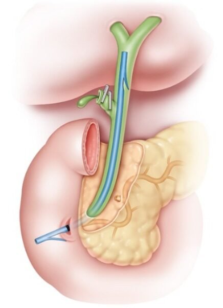 Biliary Stenting Madurai
