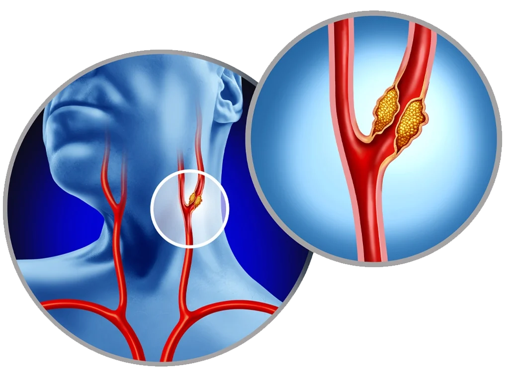 Carotid Artery Disease Treatment