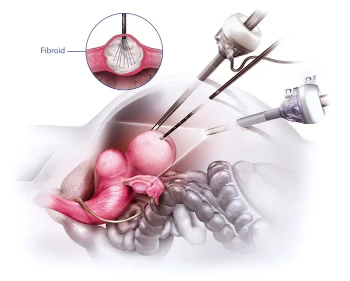 Understanding Uterine Fibroid Treatment