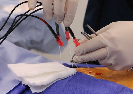 Radiofrequency Ablation Treatment