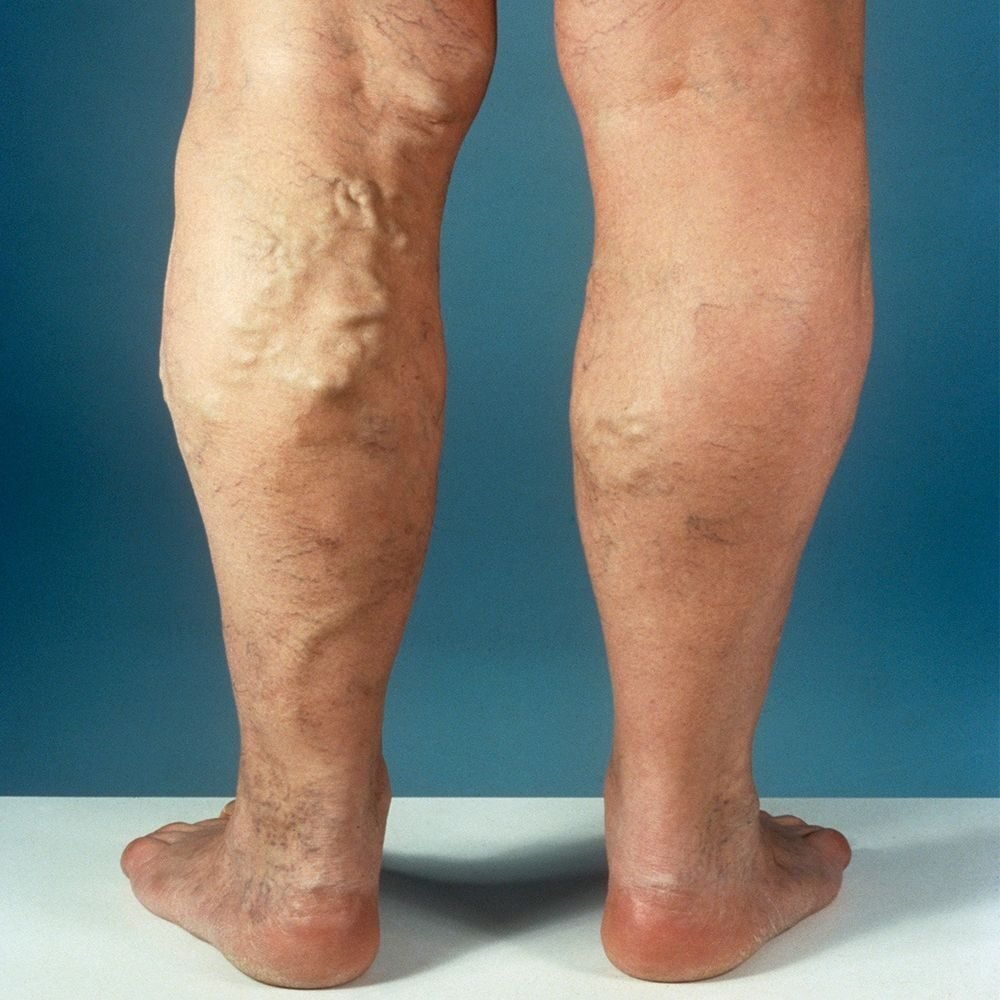 Varicose veins treatment in South Tamilnadu